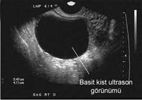 sağlıklı yumurtalık ultrason görüntüsü